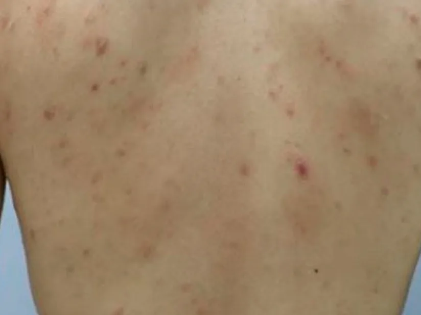 Rug met verspreide rode bultjes en enkele puistjes van milde acne