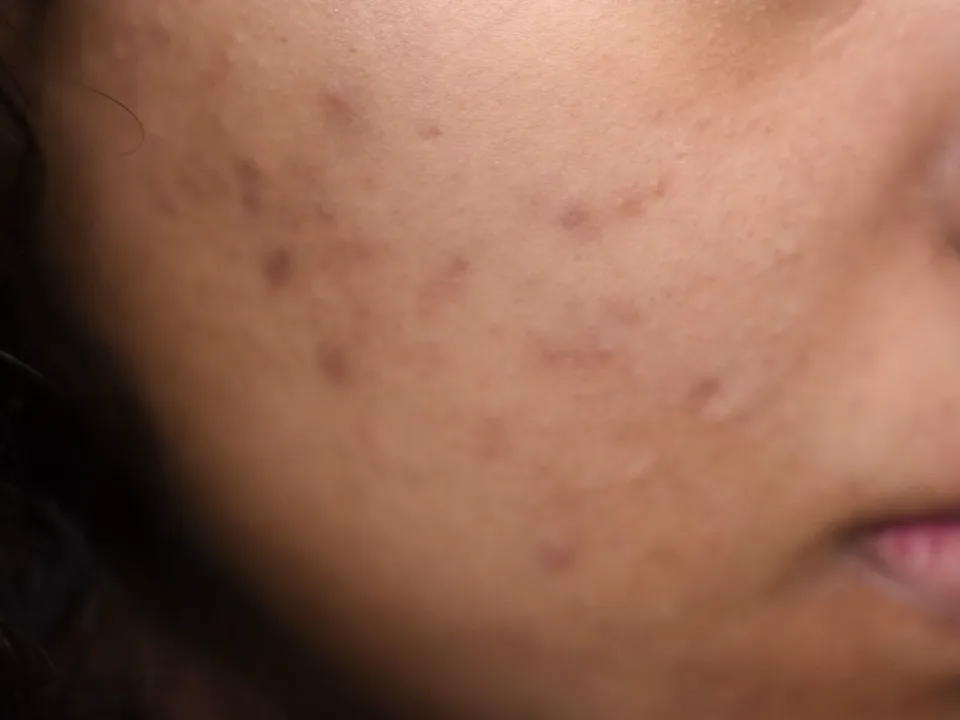 Wang van dichtbij met lichte bruine en rozige vlekjes die na acne zijn achtergebleven