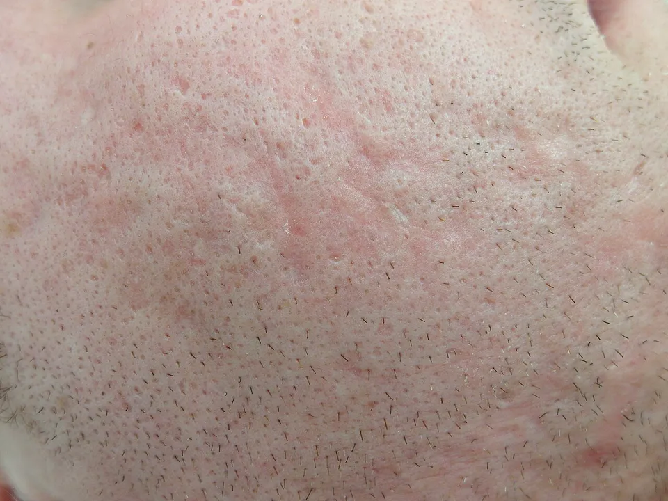 Wang met ingezonken littekens na acne