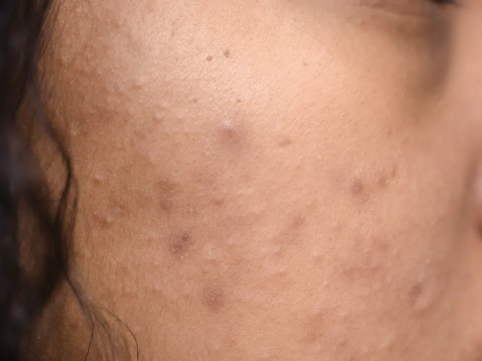 Wang met donkere vlekjes en kleine littekens na acne