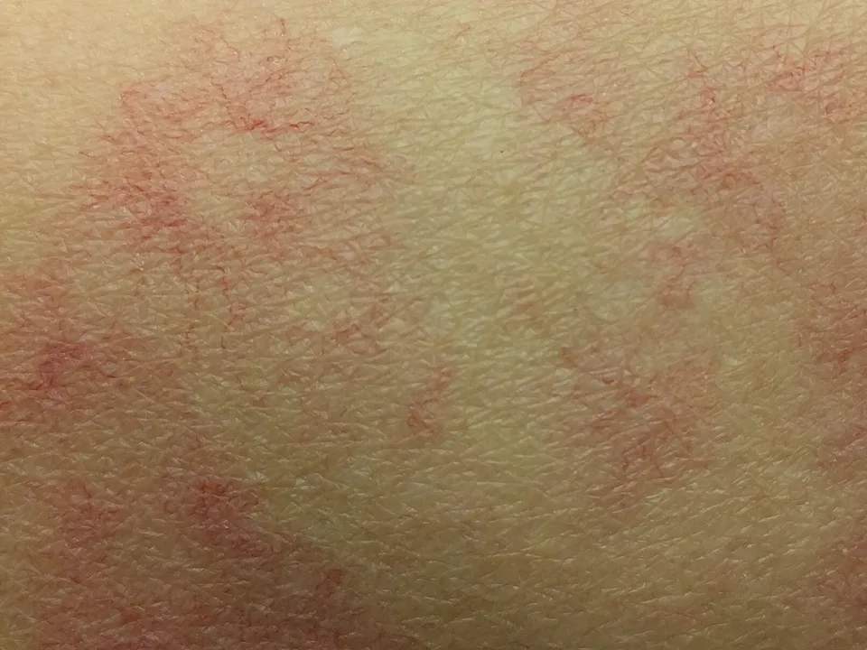 Lichte huid met een fijn netwerk van kleine rode bloedvaatjes
