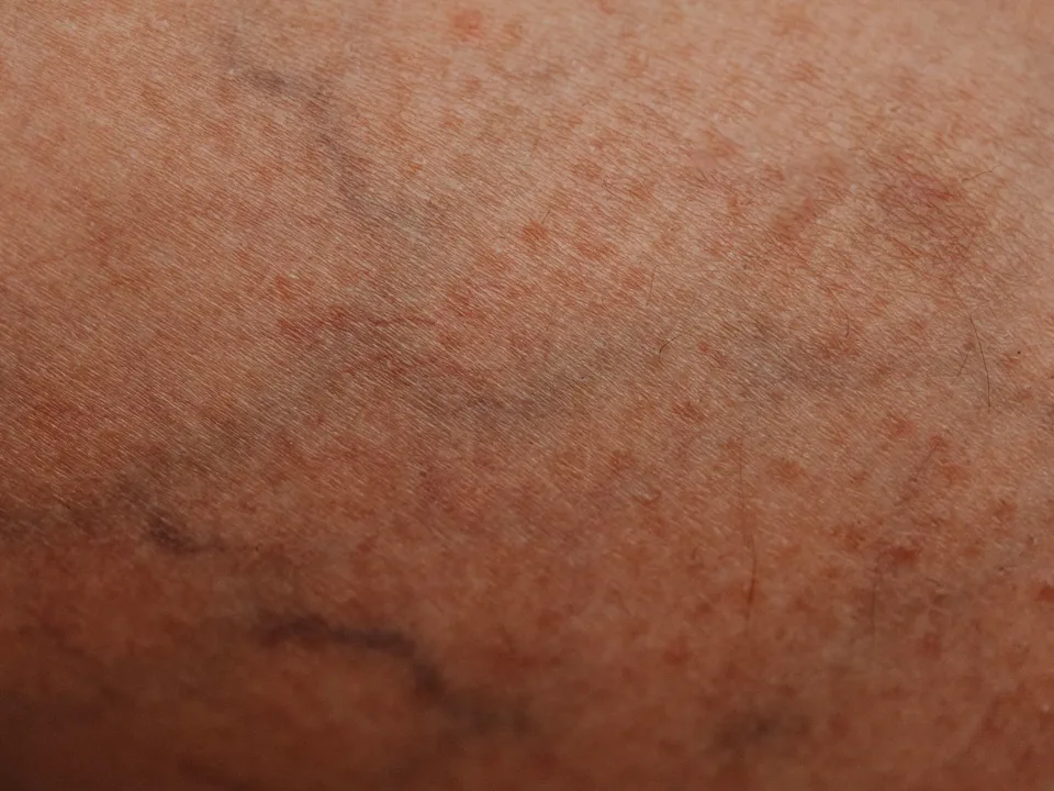 Huid van dichtbij met fijne rode en blauwpaarse adertjes