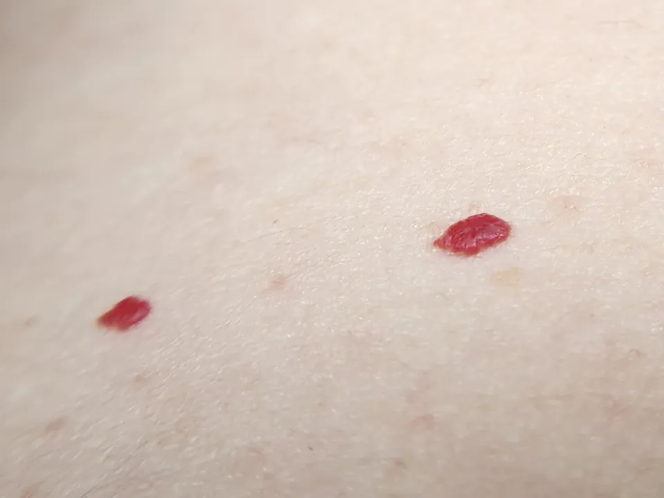 Twee kersenrode angiomen van dichtbij op een lichte huid