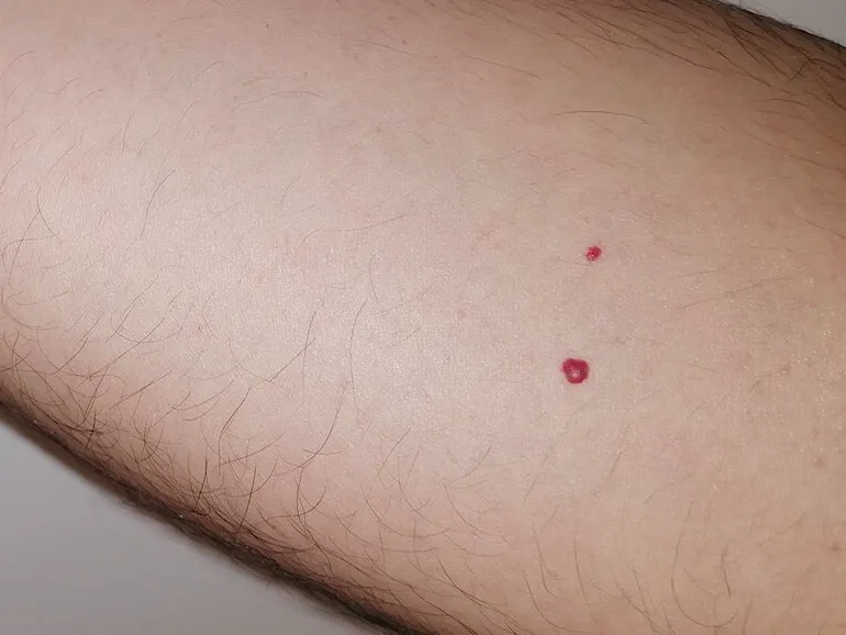 Onderarm met één klein kersenwratje van een paar millimeter