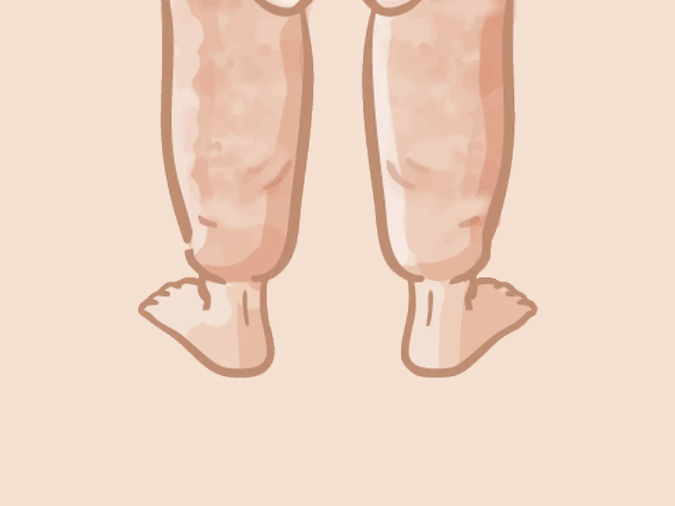 Illustratie: onderbenen en enkels, het vet stopt scherp bij de enkel (cuff sign)
