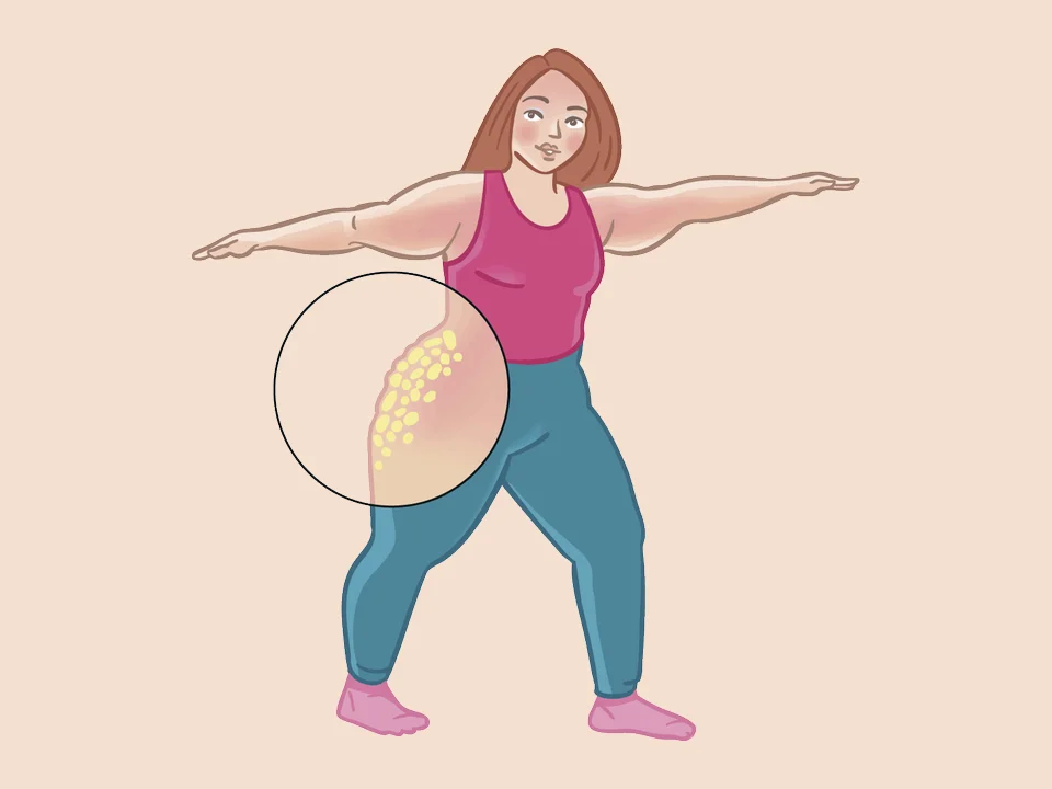 Illustratie: vrouw doet een oefening, het vetweefsel op de heup reageert niet op beweging