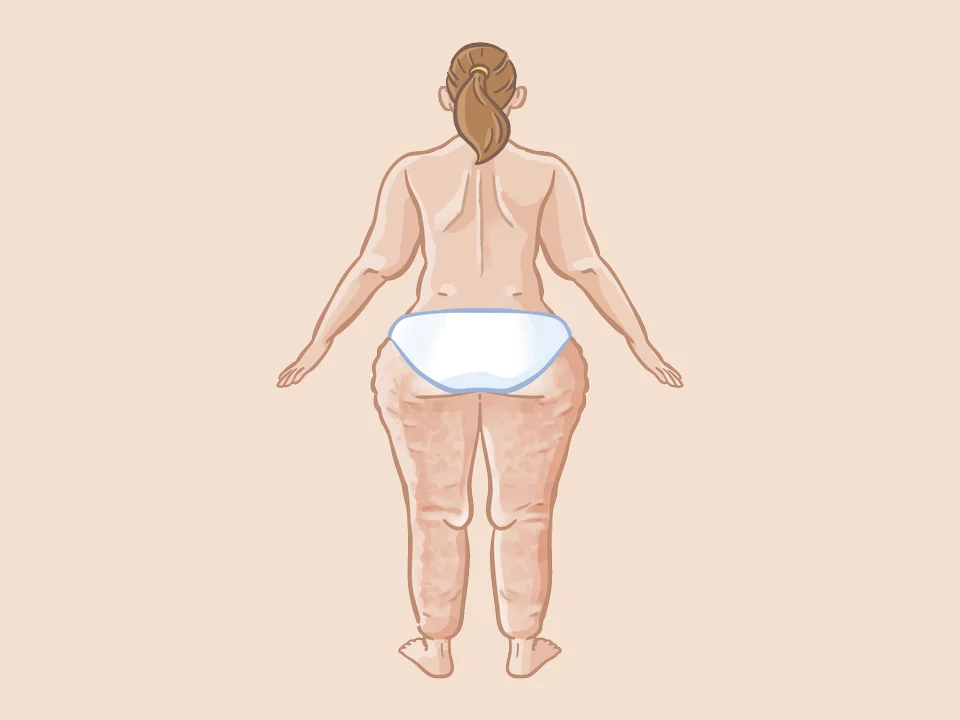 Illustratie: vrouw van achteren met vetophopingen op heupen en bovenbenen