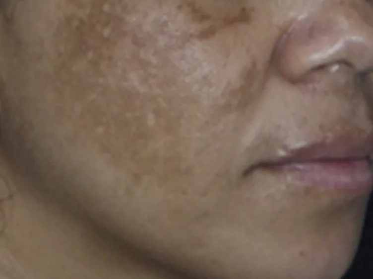 Wang en mondhoek van een vrouw met licht- tot donkerbruine, vlekkerige melasma op de wang