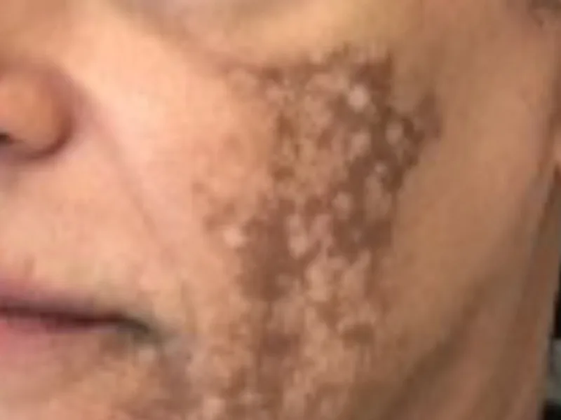 Wang van een vrouw met een bruine melasmavlek met grillige, gekartelde rand naast neus en mondhoek