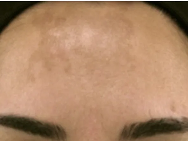 Voorhoofd van een vrouw met lichtbruine, vlekkerige melasma boven de wenkbrauwen