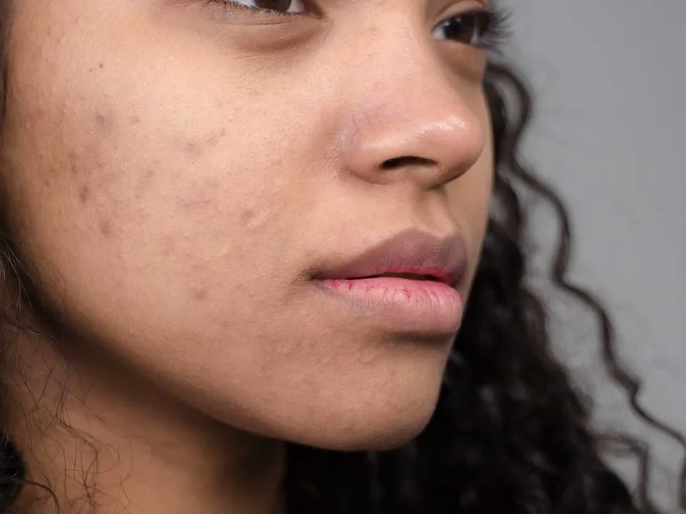 Wang en kaak van een jonge vrouw met kleine bruine vlekjes waar eerder puistjes zaten