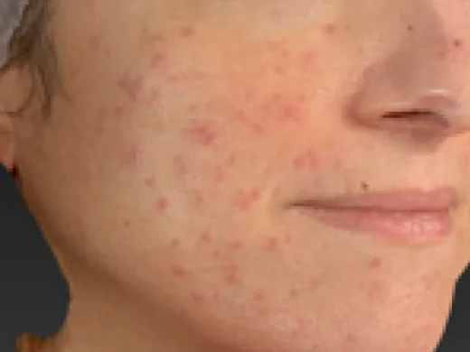 Wang met talrijke kleine rode bultjes bij papulopustuleuze rosacea