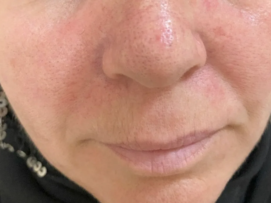 Rode, geïrriteerd ogende huid op wangen en neus bij rosacea