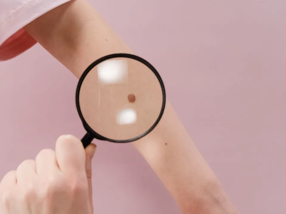 Eén klein plekje op een onderarm wordt bekeken onder een vergrootglas