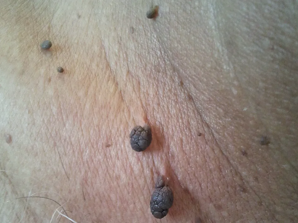 Hals met donkerbruine steelwratjes