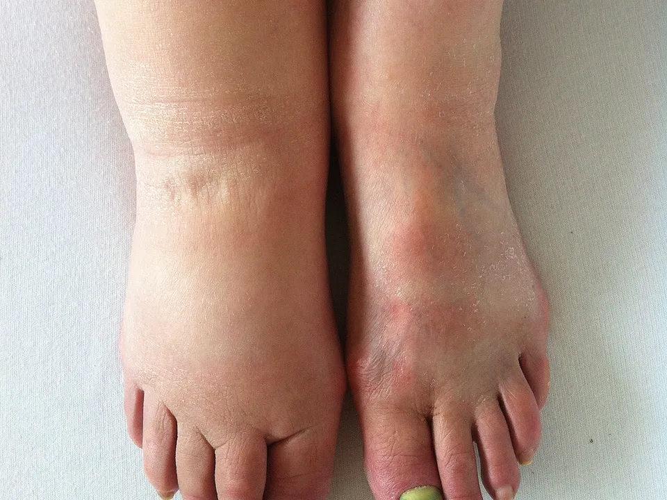 Twee voeten naast elkaar, de linker gezwollen door lymfoedeem