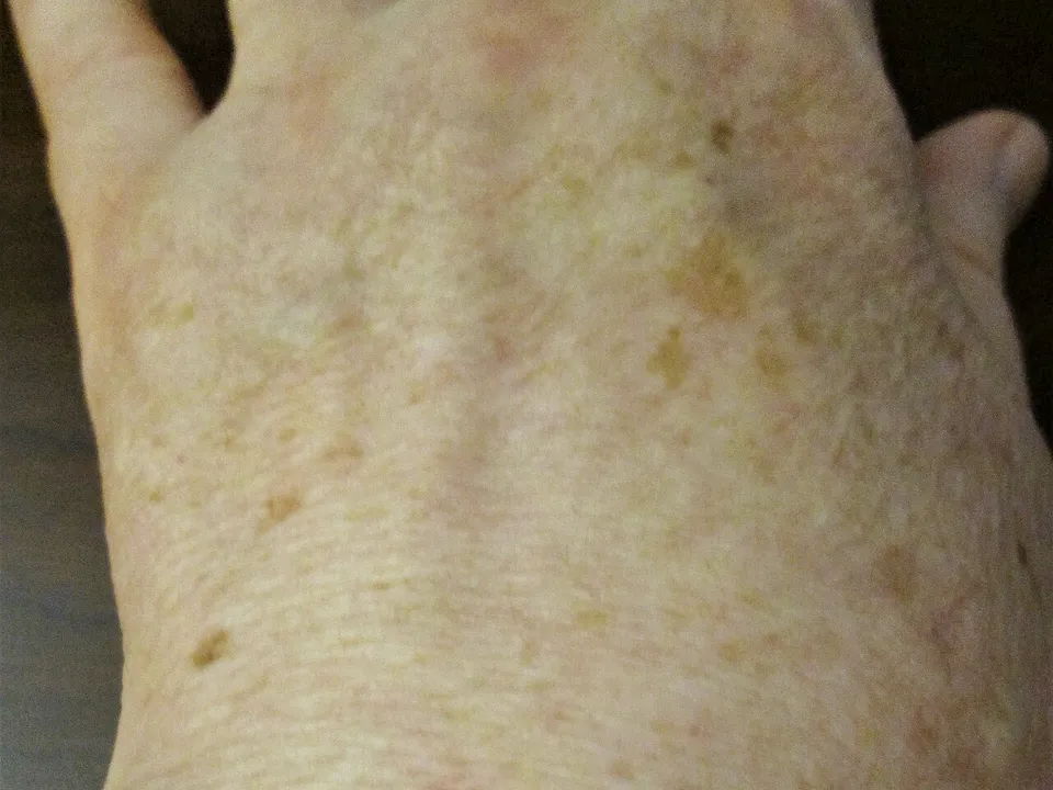 Handrug met zonnevlekken van enkele millimeters tot ruim een centimeter