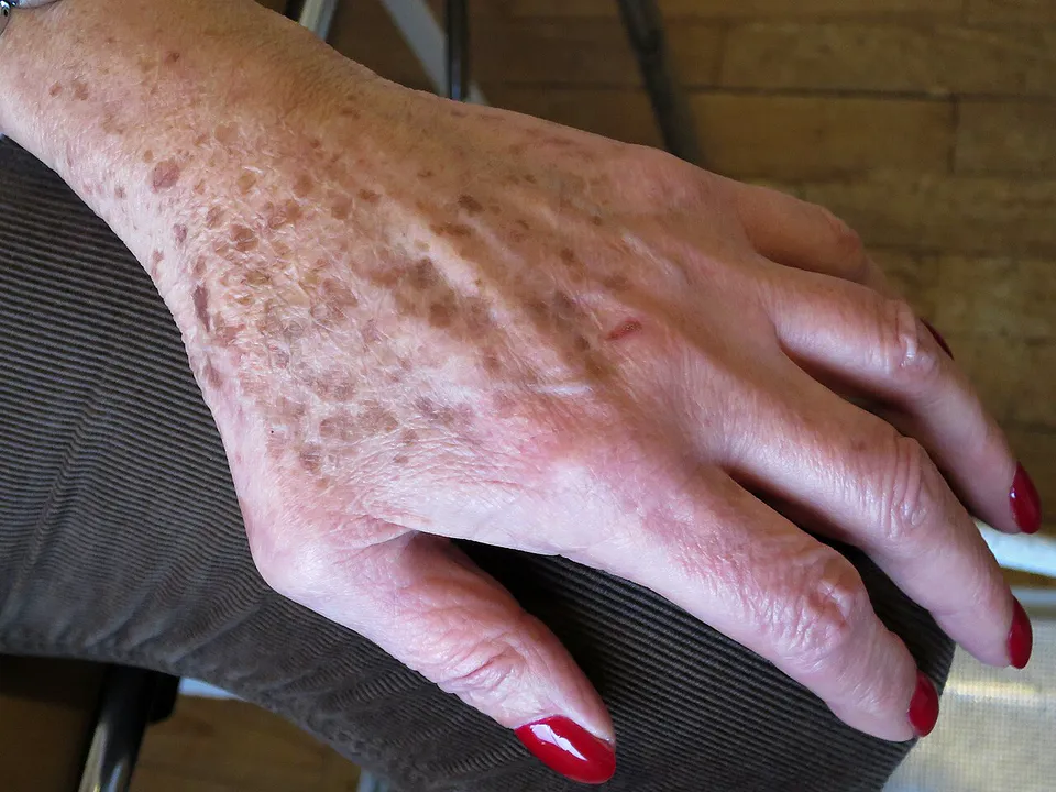 Hand van een oudere vrouw met licht- tot donkerbruine zonnevlekken